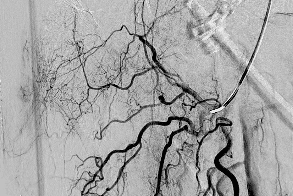 Bursitis trochanterica