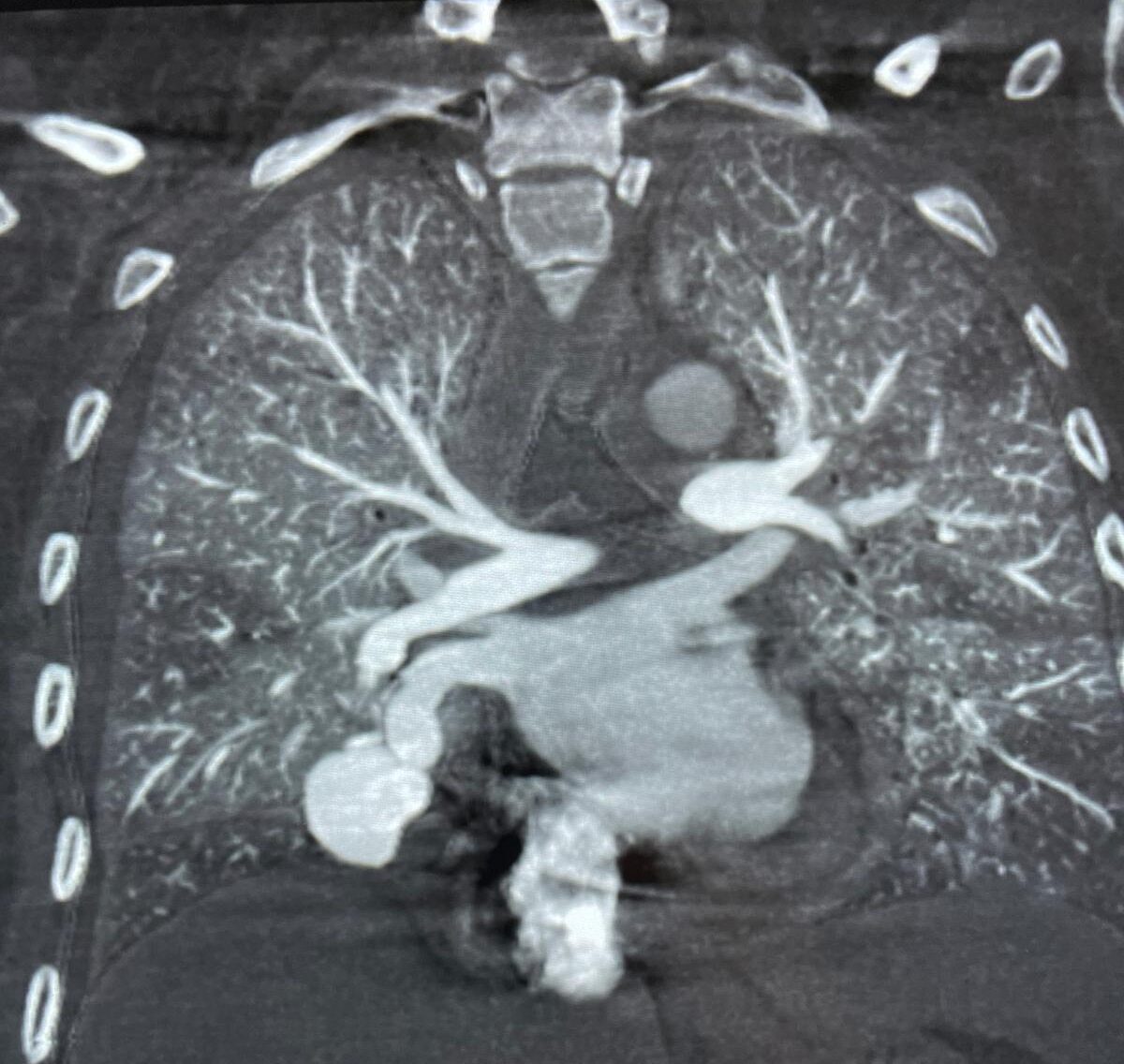 Was ist eine pulmonale AV-Malformation? - Gefäßmedizin Dr. Wolfgang Matzek