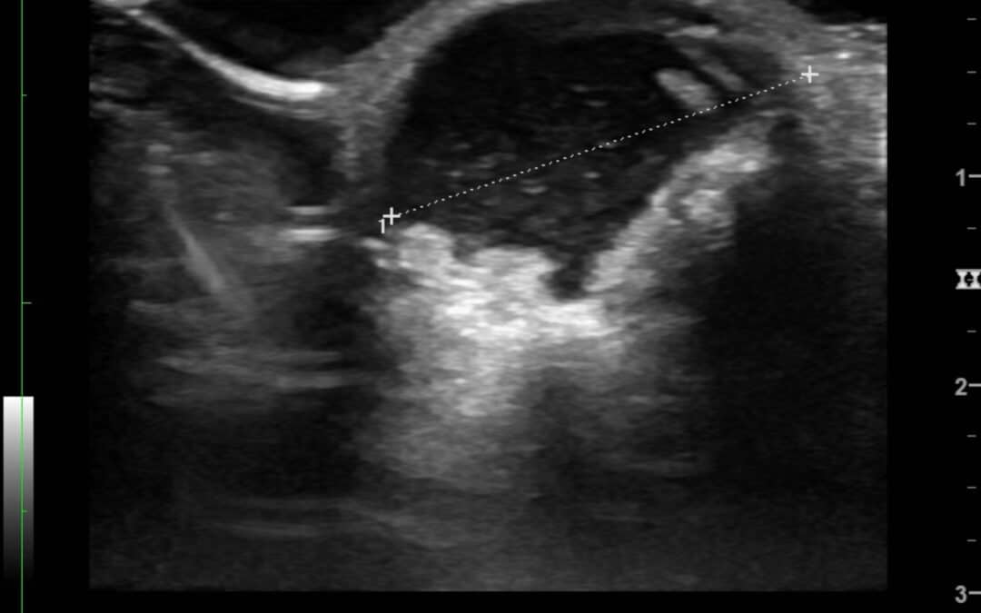 Ultraschallbild einer lymphatischen Malformation