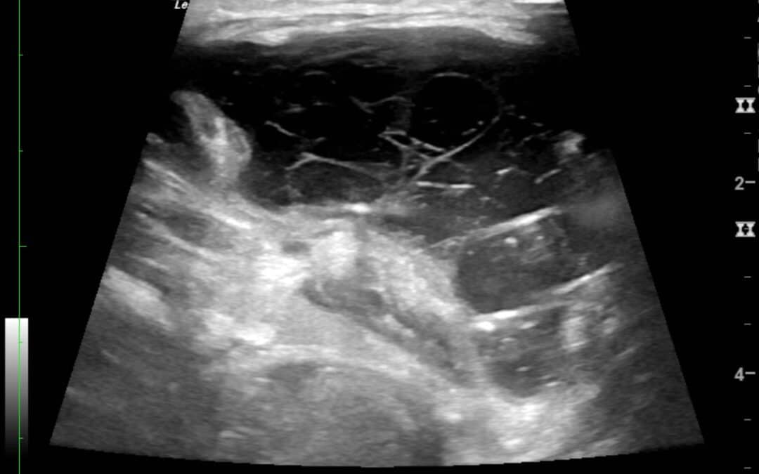 Ultraschallbild einer Speichelzyste