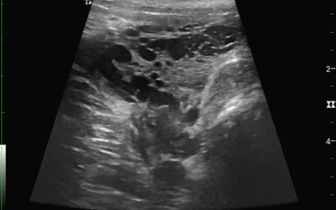 Ultraschallblíld einer Vulvavarikose